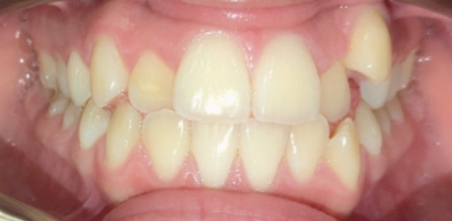 Before Image of Orthodontic Treatment in Adolescent Case with Braces: C.S.