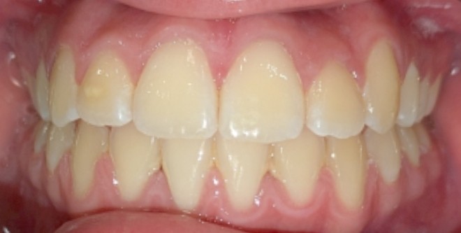 After Image of Orthodontic Treatment in Adolescent Case with Braces: C.S.