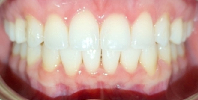 After Image of Orthodontic Treatment in Adult Case with Clear Aligners: P.A.