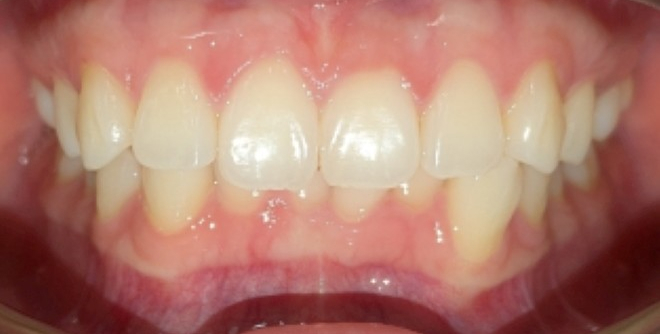 Before Image of Orthodontic Treatment in Adult Case with Clear Aligners: P.A.
