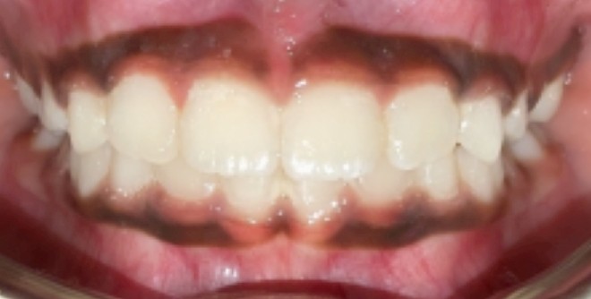 After Image of Interceptive Orthodontic Treatment (Phase 1) in Children Case with braces: V.G.