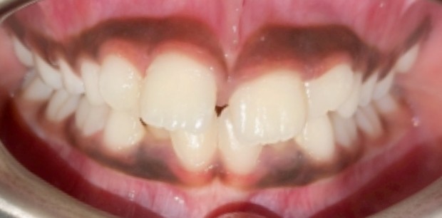 Before Image of Interceptive Orthodontic Treatment (Phase 1) in Children Case with braces: V.G.