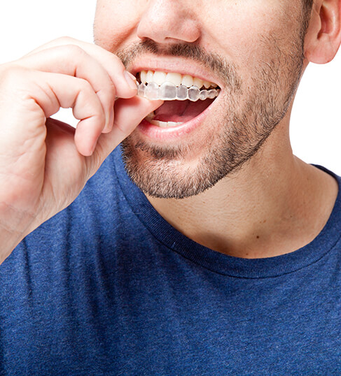 closeup of a man inserting a clear aligner onto his teeth