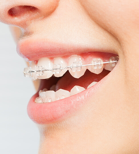 closeup of a person wearing ceramic braces