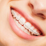 ceramic braces, clear braces
