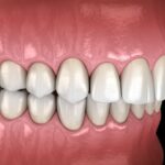 fix an overbite, braces for overbite, orthodontic treatment, Pearls Orthodontics, Pflugerville orthodontist, Dr. Patricia Ortiz, overbite correction, orthodontic care