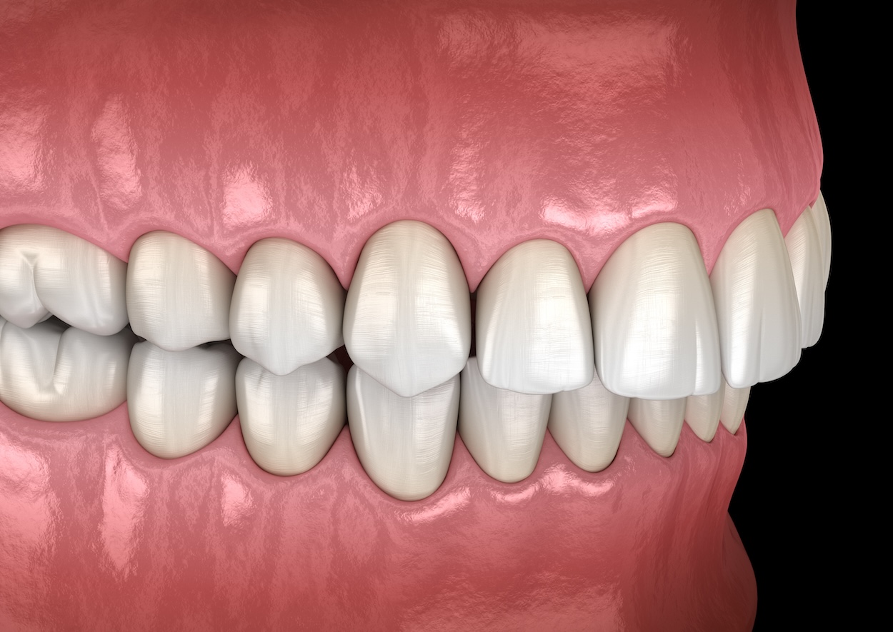 digital illustration of an overbite