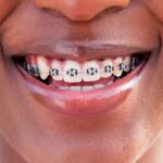 teen with braces, paying for braces, financing