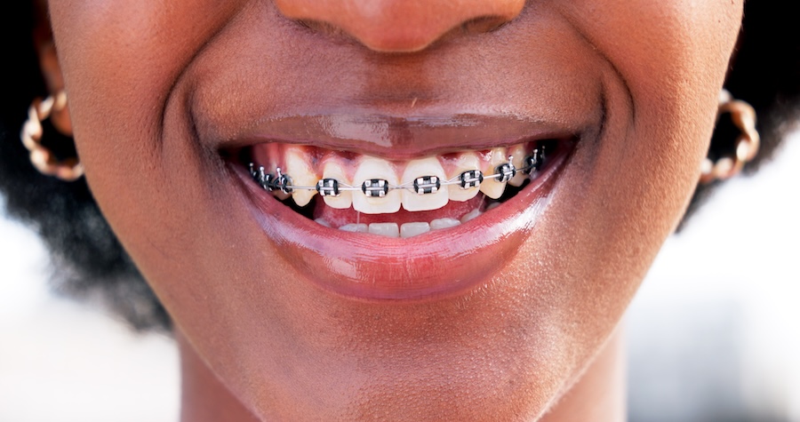 teen with braces, paying for braces, financing